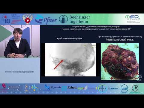 Видео: Инструментальные методы диагностики смерти мозга. Синкин МВ
