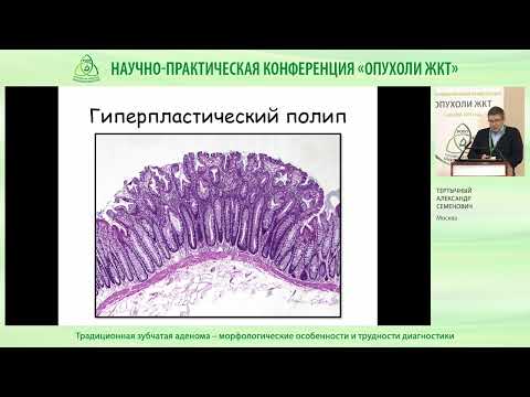 Видео: Традиционная зубчатая аденома – морфологические особенности и трудности диагности