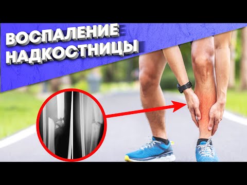 Видео: Воспаление Надкостницы. Что это? Как этого избежать? Как это лечить?