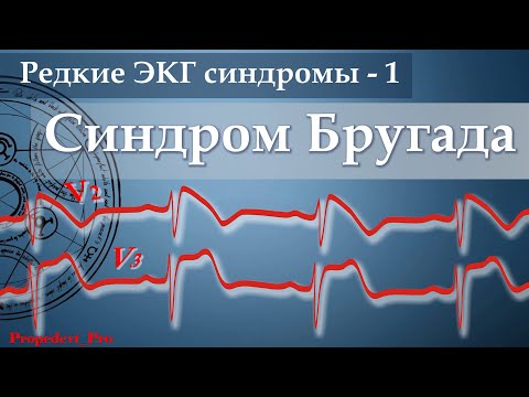Видео: Редкие ЭКГ синдромы. Синдром Бругада.