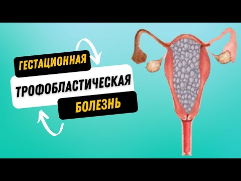 Видео: ГЕСТАЦИОННАЯ ТРОФОБЛАСТИЧЕСКАЯ БОЛЕЗНЬ @DrOlenaB #беременность #пузырныйзанос #мольнаябеременность