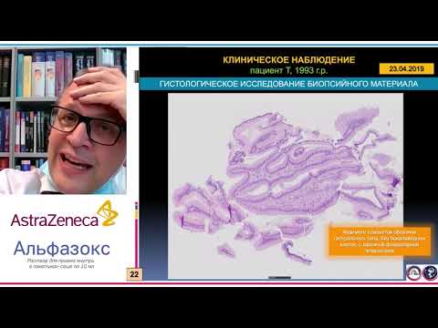 Видео: Рак пищевода Баррета у пациента 25 лет: клиническое наблюдение