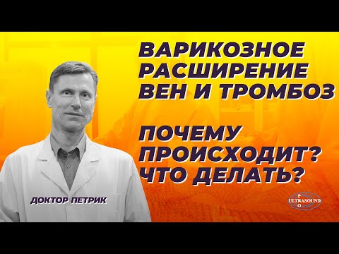 Видео: Варикозное расширение вен и тромбоз.  Почему происходит?  Что делать?
