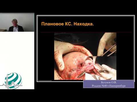 Видео: Несостоятельный рубец на матке после кесарева сечения
