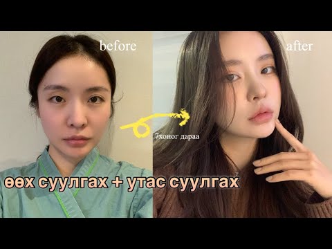 Видео: Нүүрэндээ Утас суулгах гэж очоод өөр асуудалаа ч шийдчихлээ👀💦 | өөх суулгах + утас суулгах