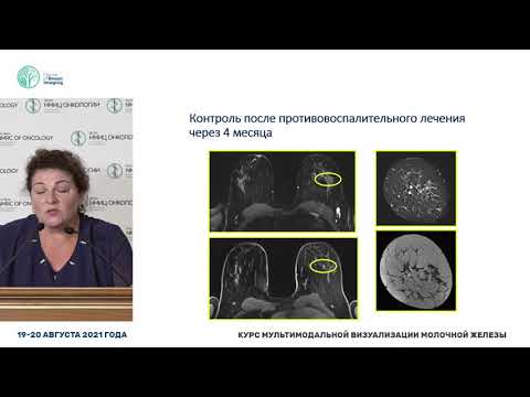 Видео: Особенности дифференциальной диагностики воспалительных изменений молочной железы и рака
