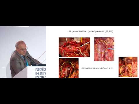 Видео: Возможности и нюансы венозных и артериальных резекций при резекциях поджелудочной железы