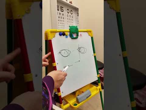 Видео: Косоглазие. Часть 4. Неаккомодационное косоглазие.