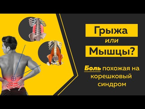 Видео: Боль в спине, отдает в ногу. Как не спутать грыжу с болью в мышцах? Техники и приемы.