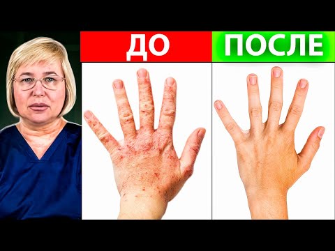 Видео: Устали от аллергии? 2 МОЩНЫХ УПРАЖНЕНИЯ ОТ АЛЛЕРГИИ
