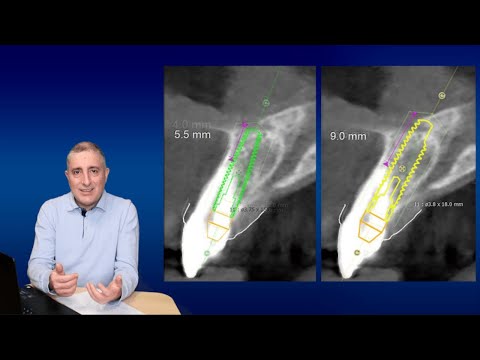 Видео: Какой длины должен быть имплант (Длина импланта)