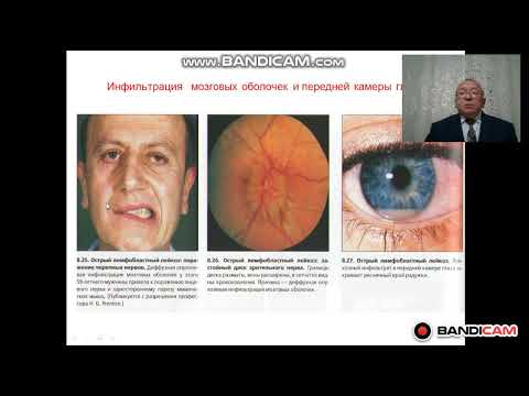 Видео: Острый лейкоз взрослых  Диагностика и лечение  Част 2