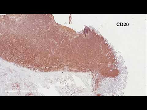 Видео: Лимфомы желудка