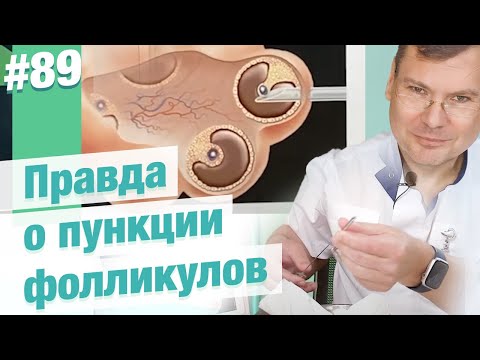 Видео: Правда о пункции фолликулов: всё, что должна знать каждая пациентка ЭКО