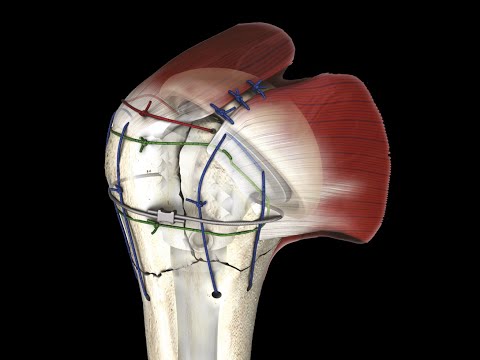 Видео: Изкуствена раменна става Mathys - Швейцария