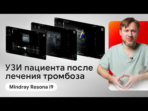 Видео: УЗИ вен нижних конечностей после лечения тромбоза на Mindray Resona i9