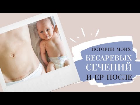 Видео: ЕР ПОСЛЕ КС | Мои истории родов 🌿