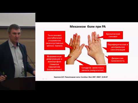 Видео: Каратеев А.Е., Современная комбинированная обезболивающая терапия: забудьте про лестницу ..