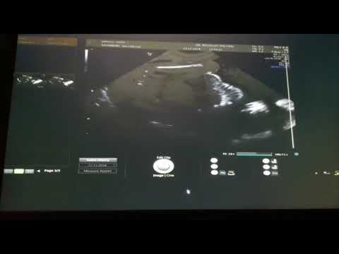 Видео: Узи на 16 неделе. Узнали пол ребёнка мальчик