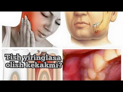 Видео: TISH YIRINGLASHI DAVOLASH, PERIODONTID/ ТИШ ЙИРИНГЛАШИ ДАВОЛАШ, ПЕРИОДОНТИД