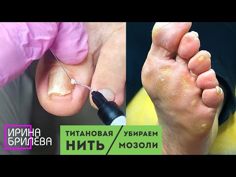 Видео: Установка Титановой нити NiTi (коррекционная система) 🌸 Склонные к врастанию ногти 🌸 Педикюр