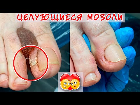 Видео: Мозоль на ноге / Целующиеся мозоли