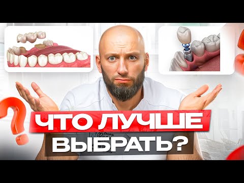 Видео: Что выбрать в 2025 году ? Мост или имплантация ?