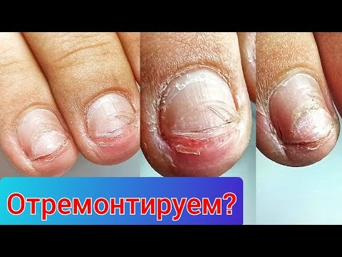 Видео: Сломанный Ноготь \ Наращивание и Опил \ Экспресс Дизайн Ногтей \ Виктория Авдеева