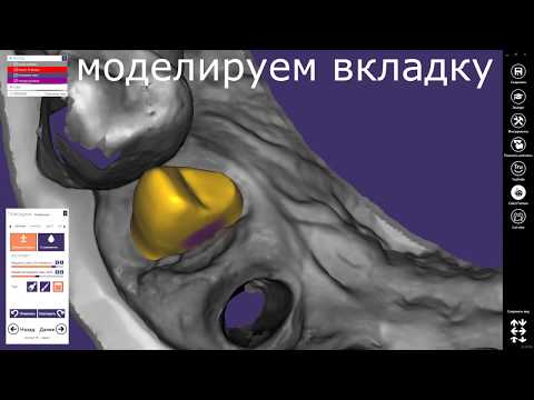 Видео: Моделирование культевой вкладки - Exocad