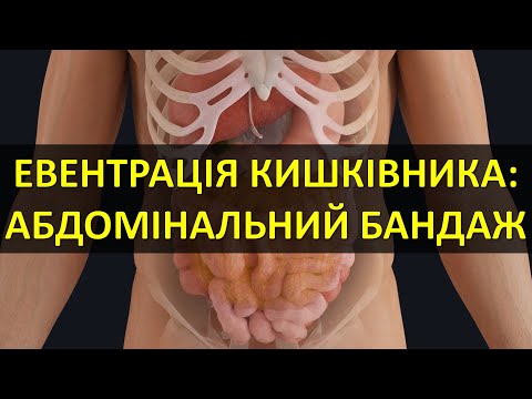 Видео: ЕВЕНТРАЦІЯ КИШКІВНИКА. АБДОМІНАЛЬНИЙ БАНДАЖ. Особливості медичної допомоги (NAR Abdominal/Stump ETD)