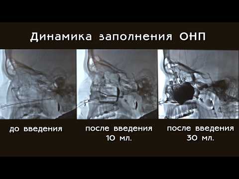 Видео: Гайморит.  Введение лекарственного препарата в пазухи при лечении гайморита. ЯМИК -процедура.
