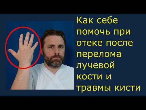 Видео: Как себе помочь при отёке после перелома лучевой кости и травмы кисти.