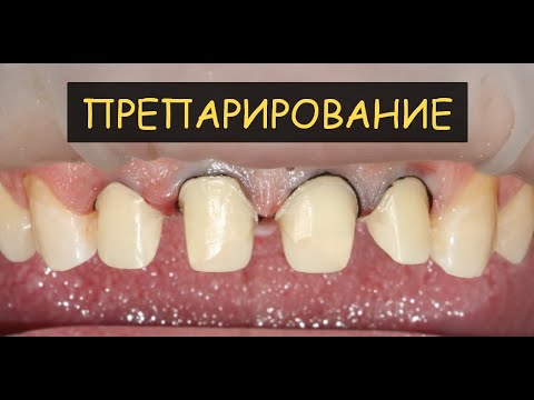 Видео: Стомат стрим ПО ПРЕПАРИРОВАНИЮ ЗУБОВ