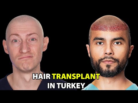 Видео: Я поехала в Турцию на пересадку волос | Реакция хирурга по волосам