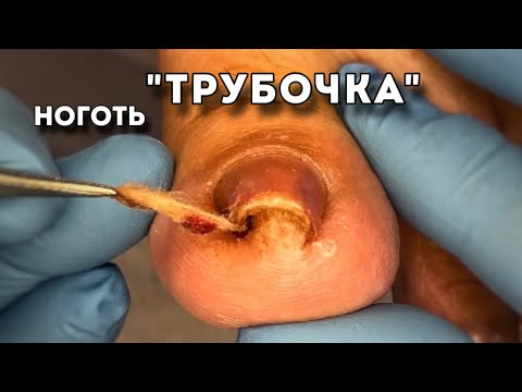 Видео: Вросший ноготь со скрученными боковыми стенками. Помогла себе сама как смогла. Стало еще хуже