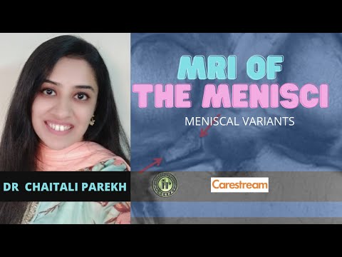 Видео: ЧАЙТАЛИ ПАРЕХ | МРТ МЕНИСКОВ – МЕНИСКАЛЬНЫЕ ВАРИАНТЫ