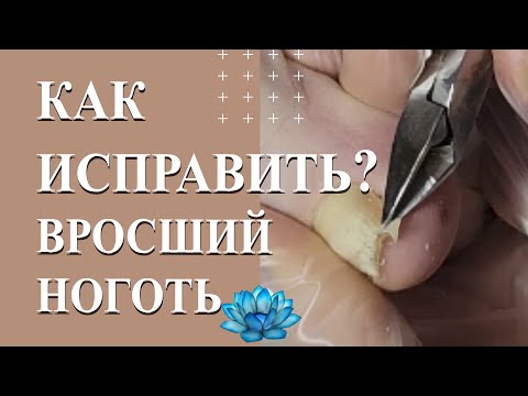 Видео: Вросший ноготь на большом пальце. Как исправить вросший ноготь.