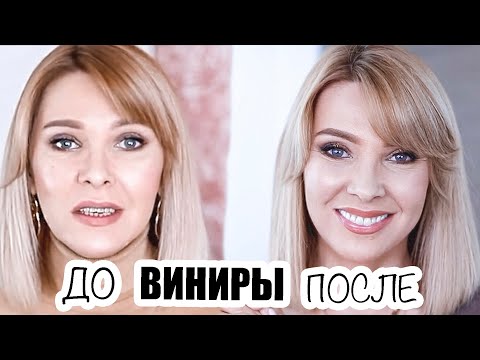 Видео: УЛЫБКА МЕЧТЫ✦ВСЯ ПРАВДА О ВИНИРАХ✦МОЯ ИСТОРИЯ✦ВИНИРЫ  И ИМПЛАНТАЦИЯ ЗУБОВ✦ТАТЬЯНА РЕВА