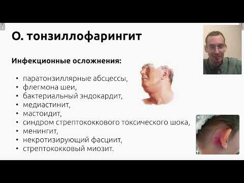 Видео: Острый тонзиллофарингит