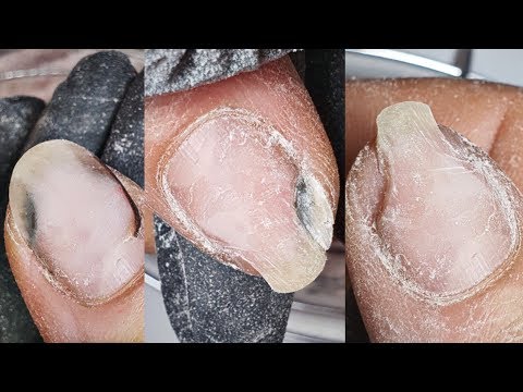 Видео: Что с НОГТЕМ!?😱 продолжение истории ногтей с онихолизисом....