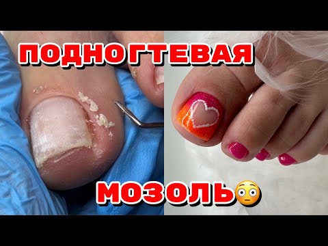 Видео: Как убрать подногтевую мозоль 🦶Педикюр 🦶дизайн ногтей на ногах