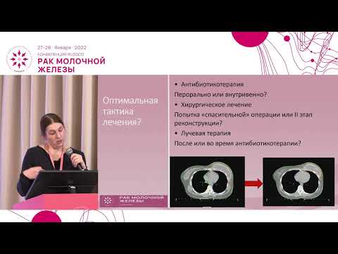Видео: Потеря эспандера после лучевой терапии РМЖ: хирургический брак, осложнения ЛТ или закономерность?
