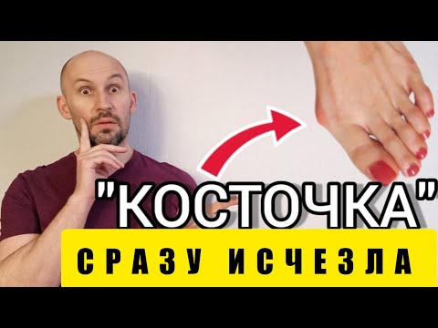 Видео: Косточка на большом пальце ноги ушла НАВСЕГДА за 5 МИНУТ