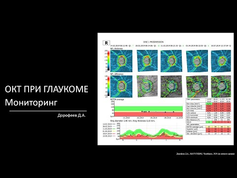 Видео: ОКТ при глаукоме  Мониторинг и структурно функциональные корреляции 6/7