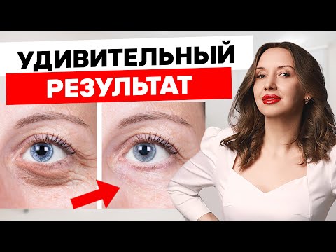 Видео: Как убрать морщины и нависшее веко? Секреты ухода за кожей вокруг глаз