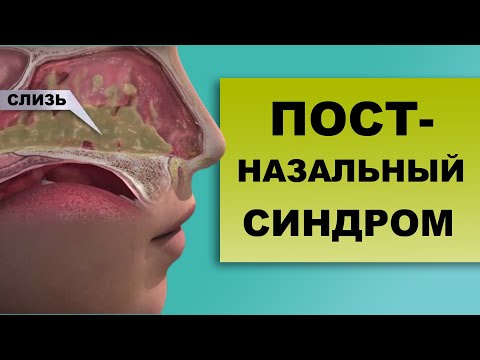 Видео: ПОЧЕМУ СТЕКАЕТ ПО ЗАДНЕЙ СТЕНКЕ ГОРЛА