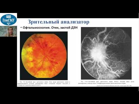 Видео: Зрительный нерв методы исследования, симптомы поражения