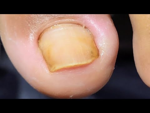 Видео: ОНА ПРОВЕЛА 3 МЕСЯЦА С ТАКИМ НОГТЕМ НА НОГЕ (с субтитрами)