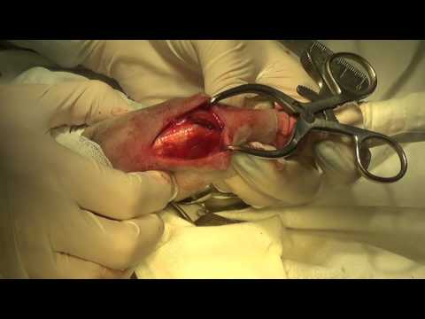 Видео: Разрыв ПКС - анкерный фабелло-тибиальный шов