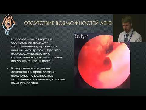 Видео: ЭКМО у пациентов высокого риска